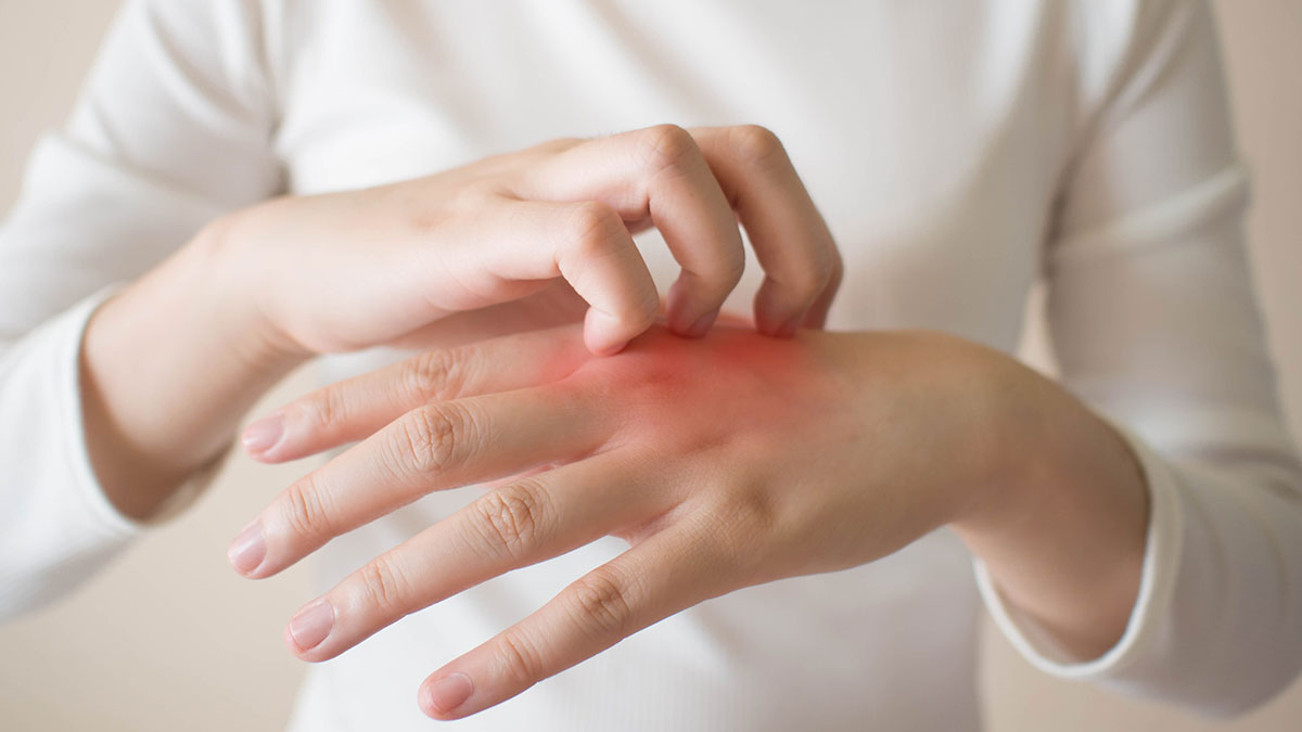 JHAH Well-Being: How to identify, diagnose, and treat eczema