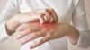 JHAH Well-Being: How to identify, diagnose, and treat eczema